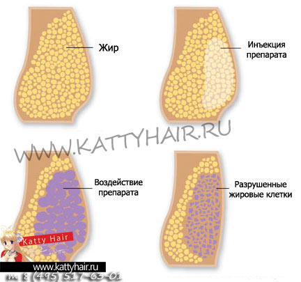 мезотерапия мезотерапия